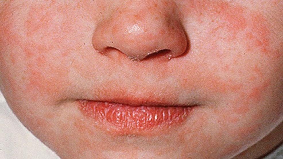 Measles exposure at Seattle Children's Hospital - KOMO News thumbnail