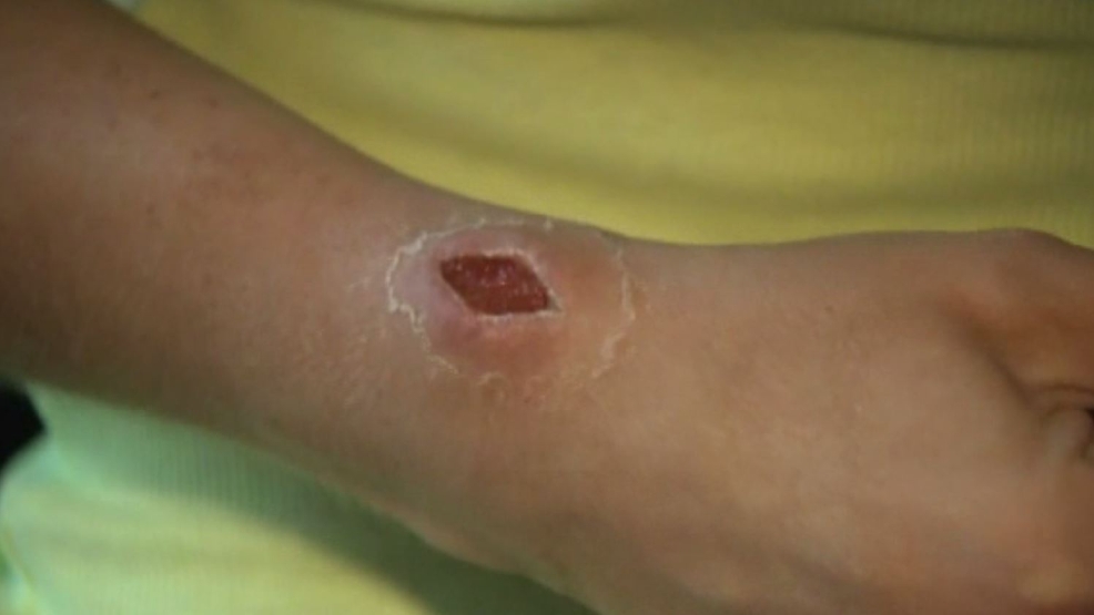 Woman Undergoes Emergency Surgery After Hair Tie Causes Infection