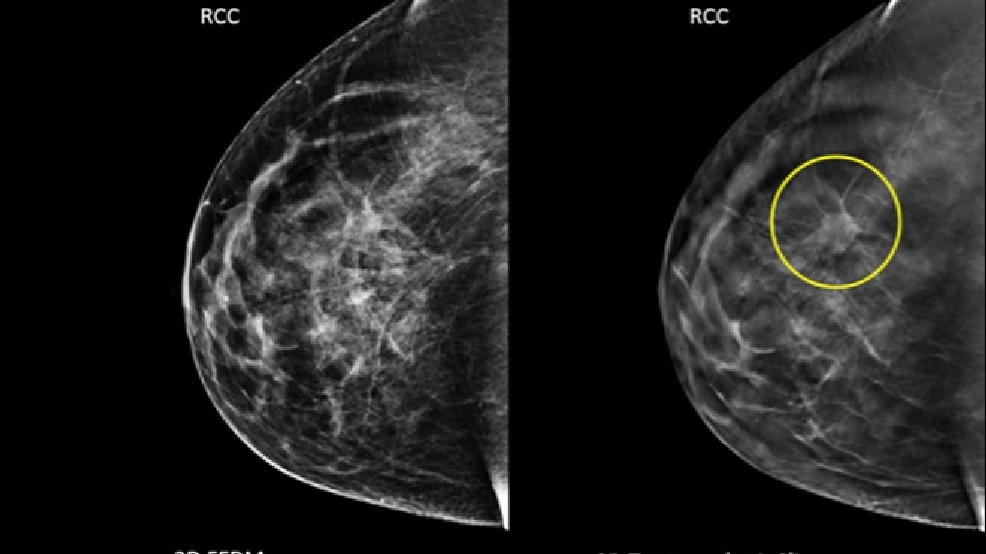 3-d-mammogram-scans-may-find-more-breast-cancer-komo