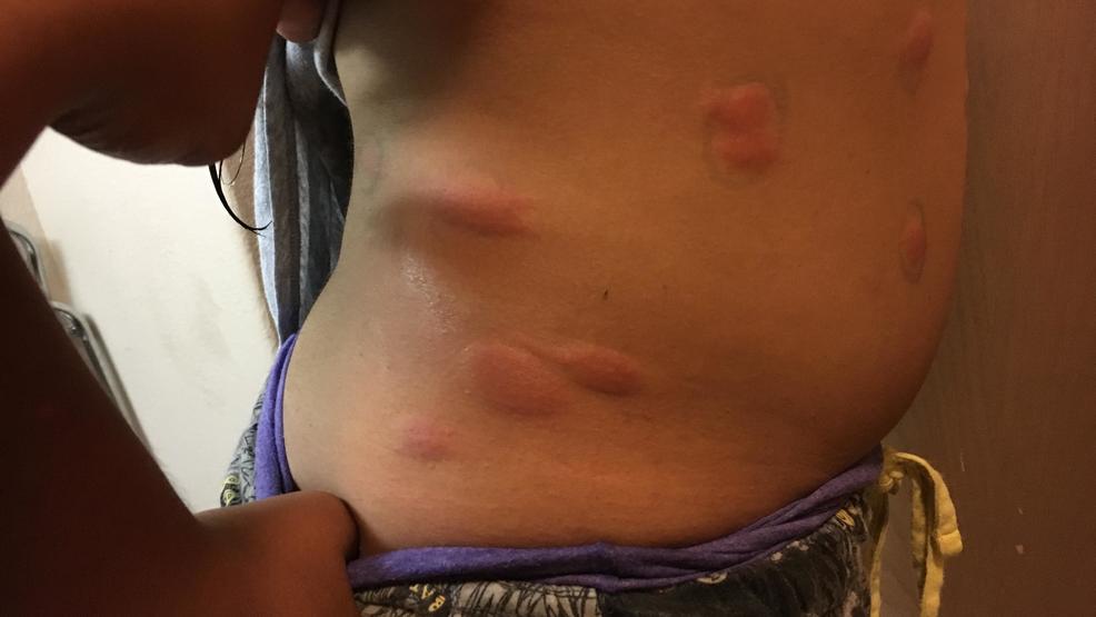 NM mother blames daughter’s bites on motel bedbugs KDBC